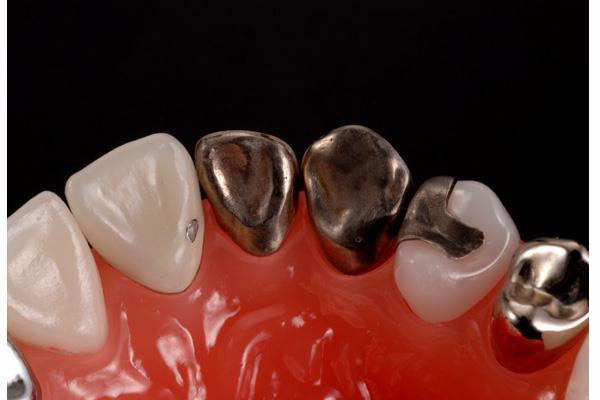 白い歯の比較