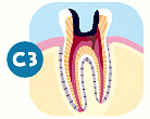 第3段階(C3)