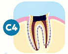 第4段階(C4)