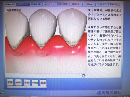 患者説明用アニメーション