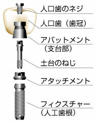 インプラントの構造(イメージ)